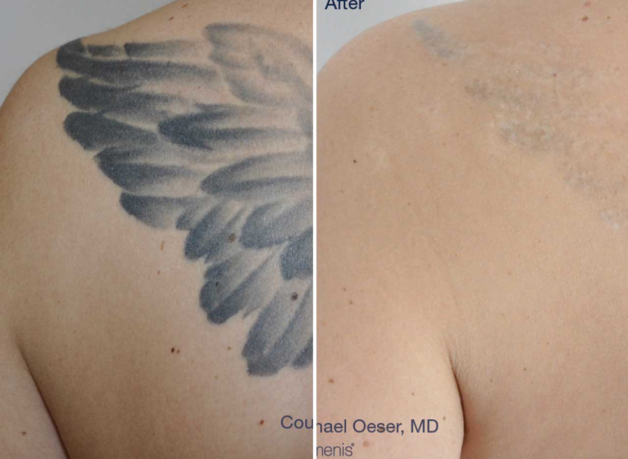 Tattoo Removal | Theerathorn Clinic