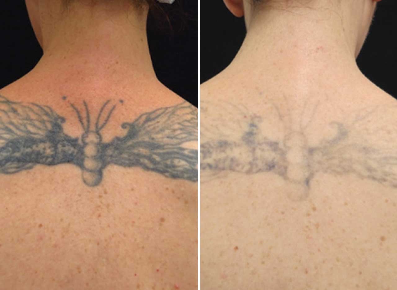 How Laser Tattoo Removal Works? A Step-By-Step Guide